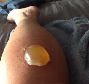 piqûre de frelon réaction allergique